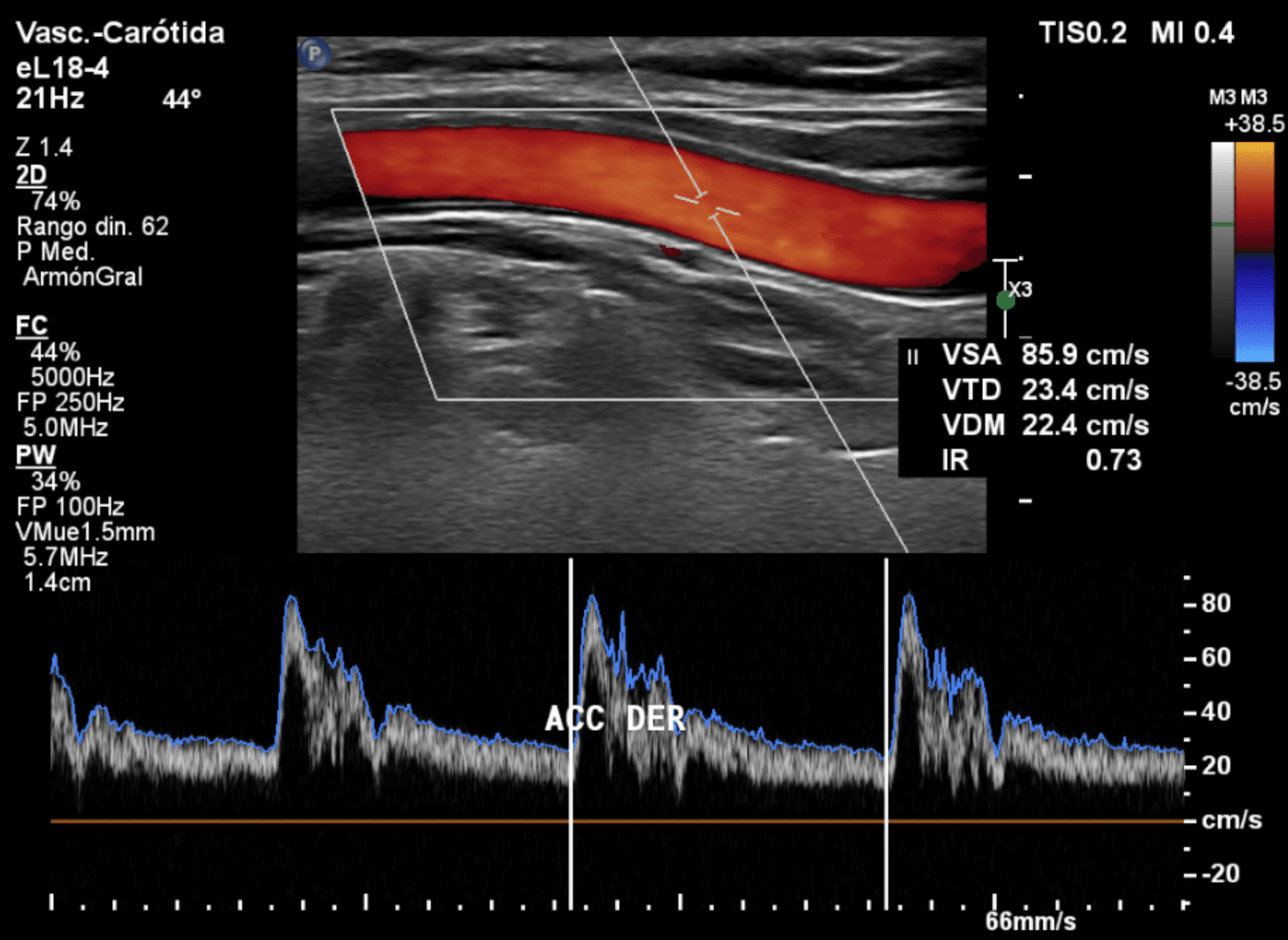 Ultrasonido Doppler carotídeo con registro espectral