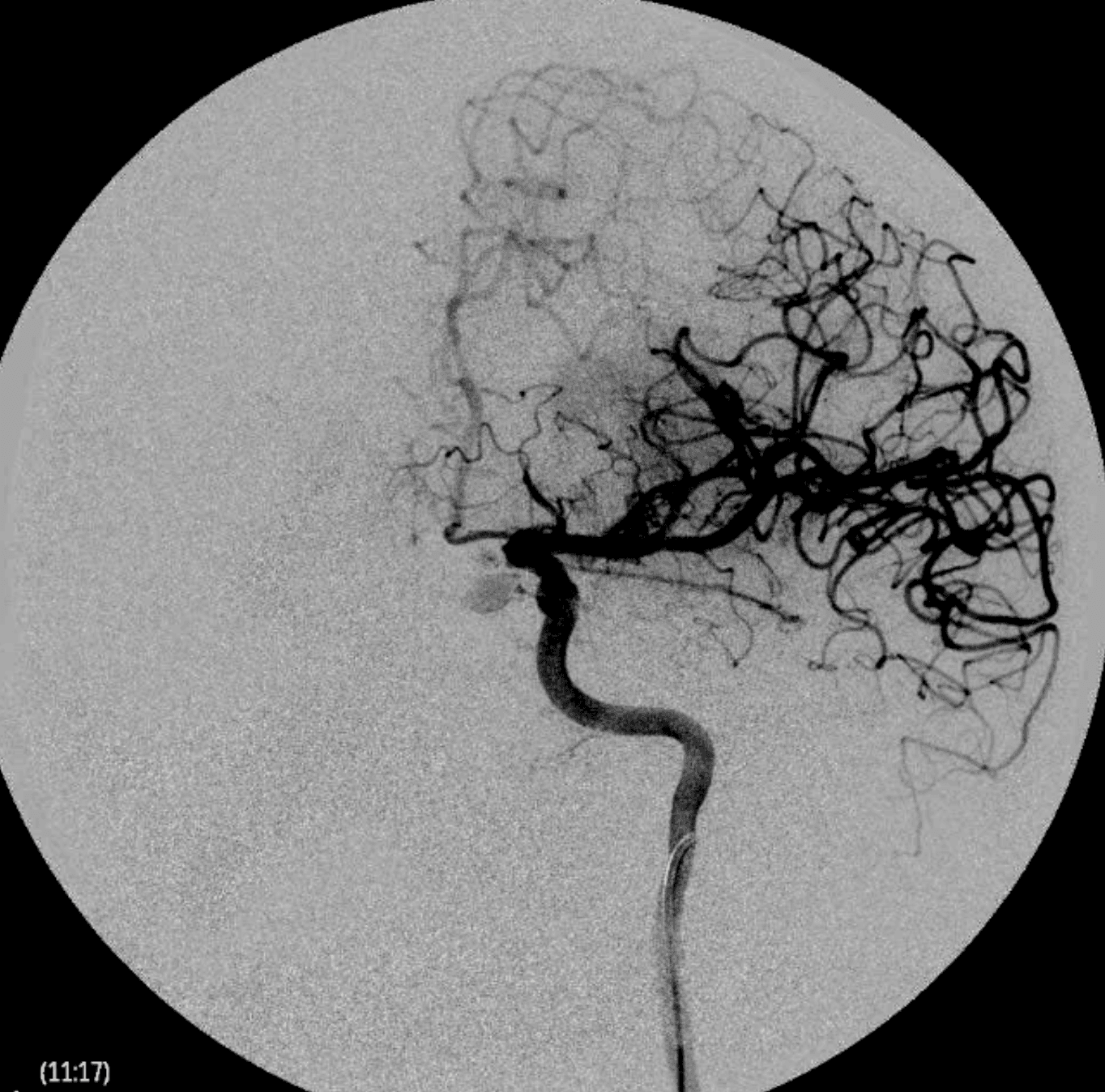 Estudio angiográfico cerebral con representación vascular