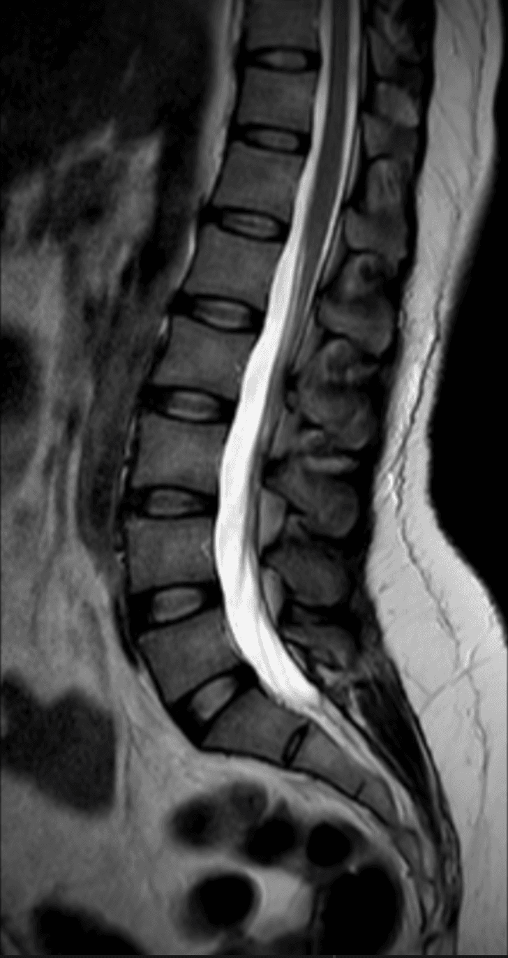 Imagen de resonancia magnética lumbar